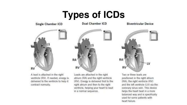 pace prevention-of-sudden-cardiac-death-with-implantable-cardiac-defibrillators-in-children-and-adolescents-with-hypertrophic-cardio-myopathy-6-638